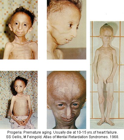 progeria.jpg